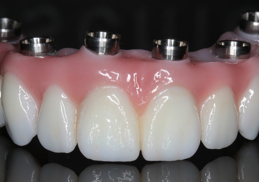 Overdenture Design to Maximize Stability and Function | Dentistry Today CE