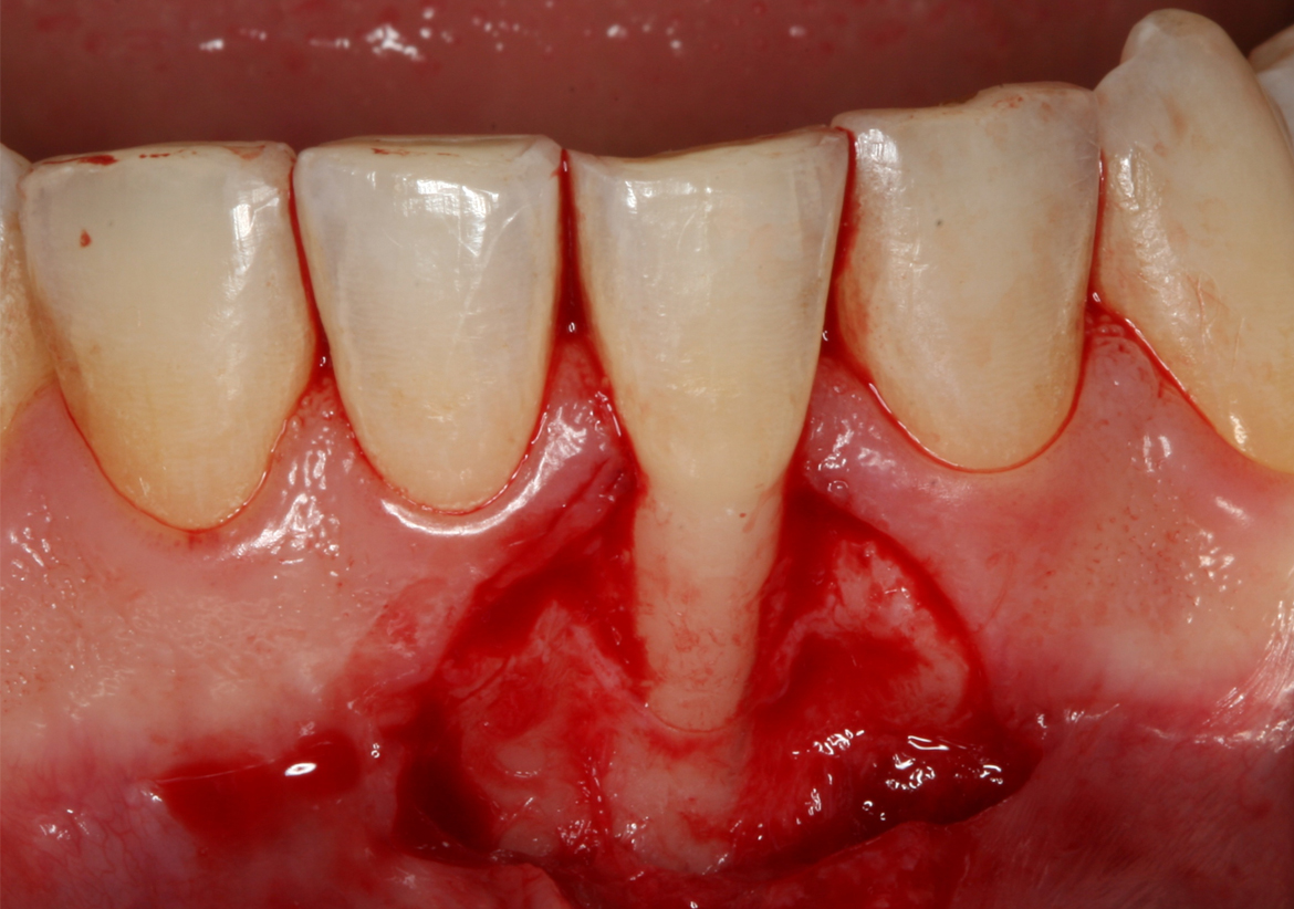 Management Of Mandibular Anterior Teeth With Gingival Recession (#182 