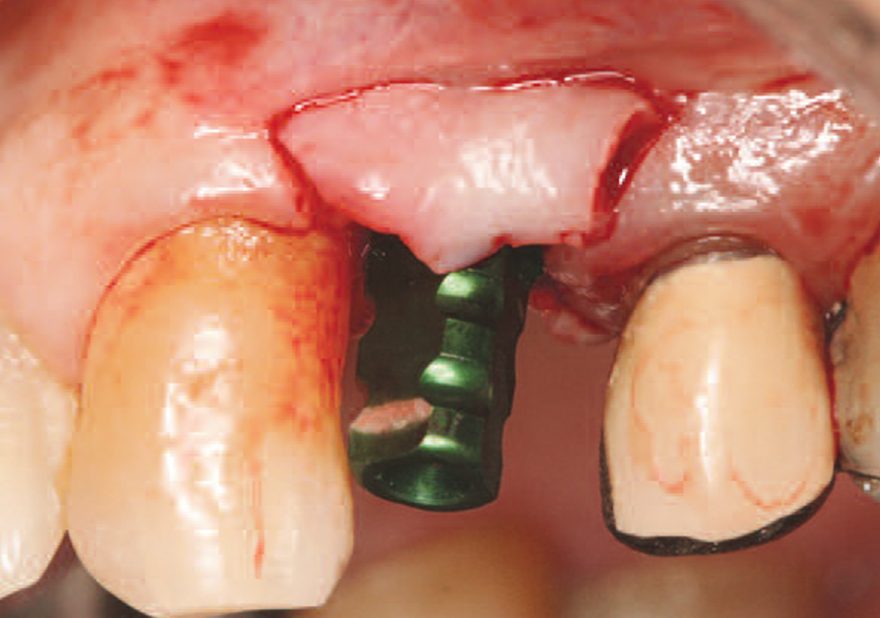 Immediate Dental Implant Placement: Technique, Part 1 (#169 ...