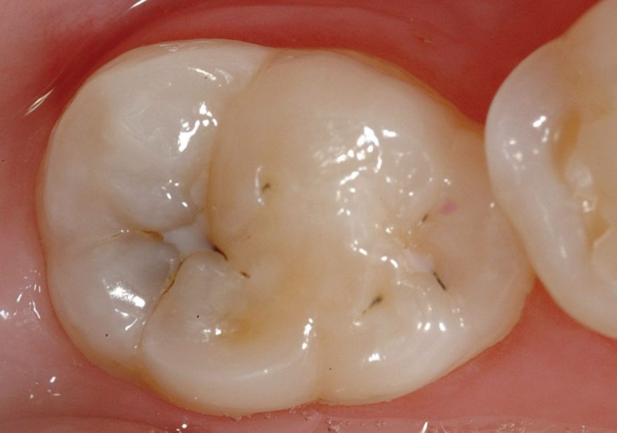 research articles on dental caries