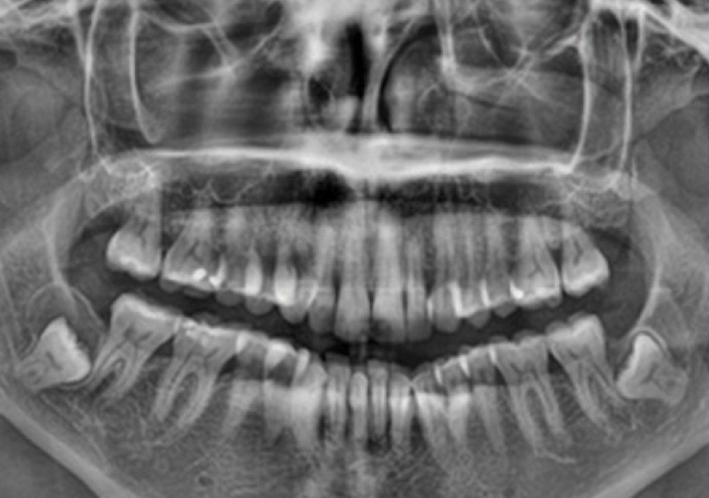 Diagnosis And Treatment Of A Dentigerous Cyst 255 Dentistry Today Ce 2426