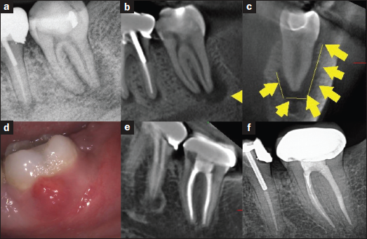 Myth of the “J-Shaped” Lesion (#263) | Dentistry Today CE